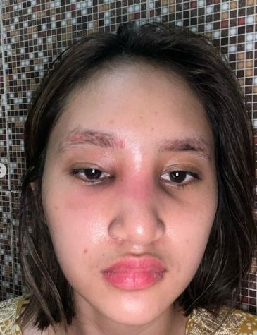 Potret hidung Permesta Dhyaz bengkak usai operasi [Instagram/@permestadhyaz]