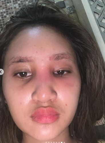 Potret hidung Permesta Dhyaz bengkak usai operasi [Instagram/@permestadhyaz]