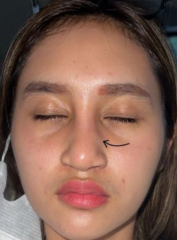 Potret hidung Permesta Dhyaz bengkak usai operasi [Instagram/@permestadhyaz]