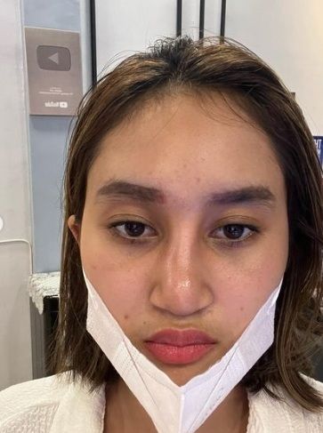 Potret hidung Permesta Dhyaz bengkak usai operasi [Instagram/@permestadhyaz]