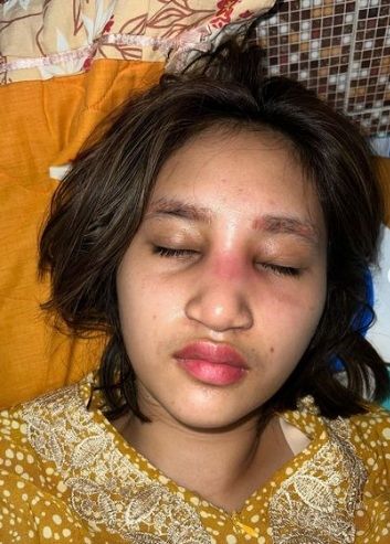 Potret hidung Permesta Dhyaz bengkak usai operasi [Instagram/@permestadhyaz]