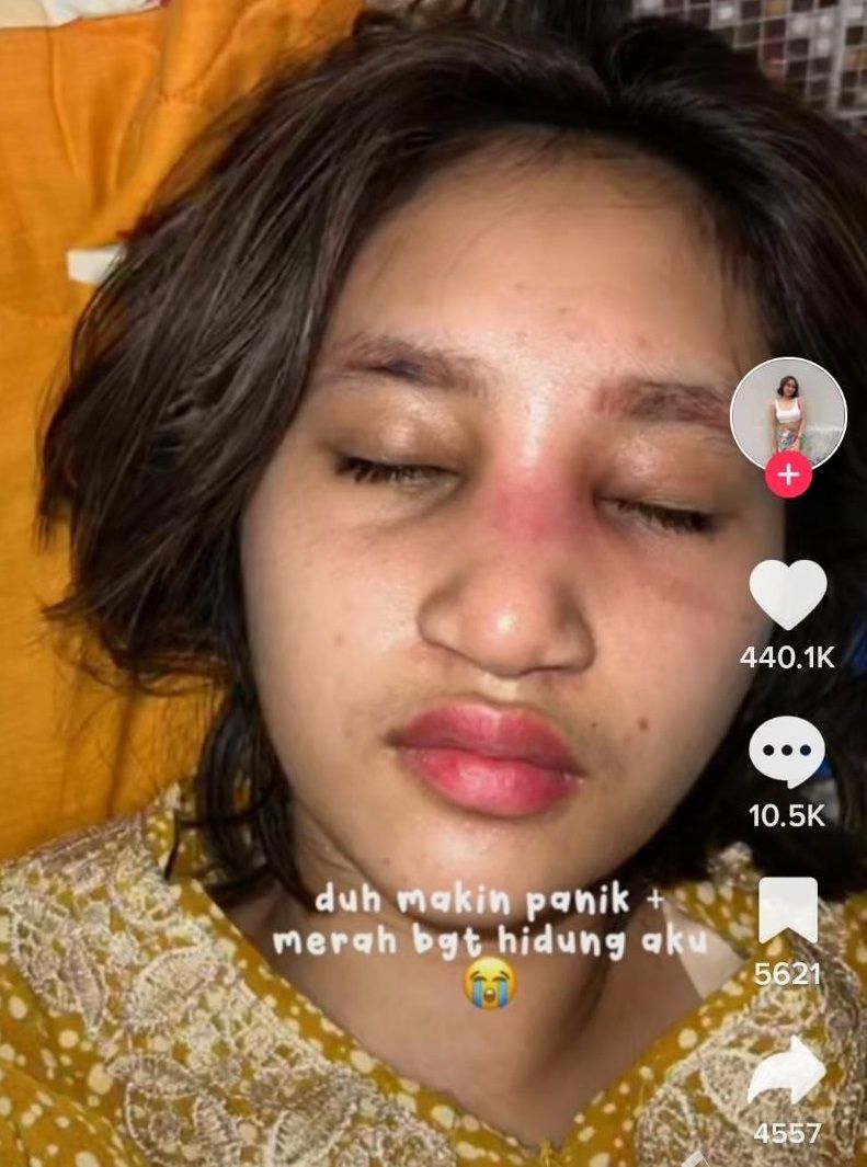 Putri Farida Nurhan, Permesta Dhyaz mengalami bengkak di wajah akibat operasi plastik. [Instagram]