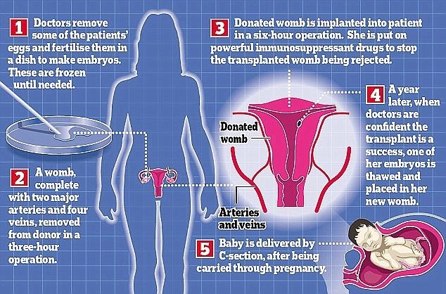 Penelitian Dr Narendra Kaushik, transplantasi rahim ke perempuan transgender. [Daily Mail]