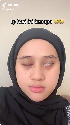 Viral! Gegara Keseringan Kena Kipas Angin, Wajah Perempuan Ini Alami Bell's Palsy. (Dok: TikTok/juliyuliaa )