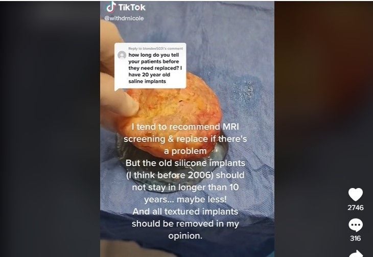 Viral Dokter Keluarkan Implan Payudara Berusia 35 Tahun yang Pecah, Penampakannya Malah Mirip Donat Jeli. (Dok: TikTok)