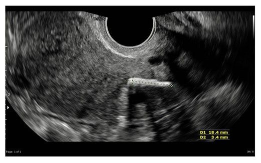 Tulang janin mati di dalam rahim (Clinical Case Reports)
