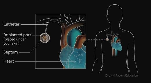 Pamasangan chemo port (University Health Network Journal)