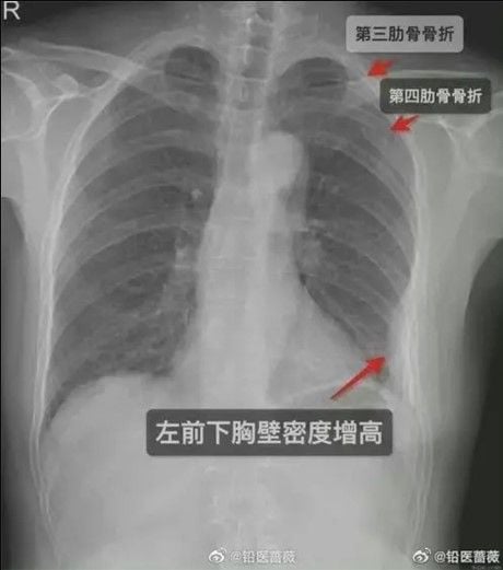 Hasil x-ray tulang rusuk sang wanita (Weibo)