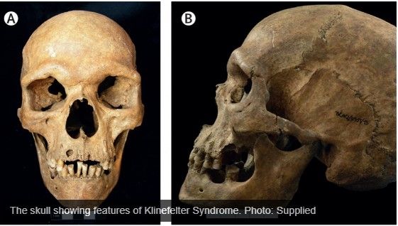 Kerangka manusia yang menderita sindrom Klinefelter (Australian National University)