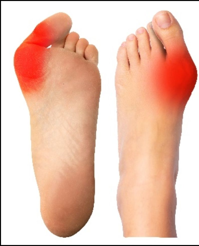 Ilustrasi cedera kaki karena salah pilih sepatu. (dok. RSPI)