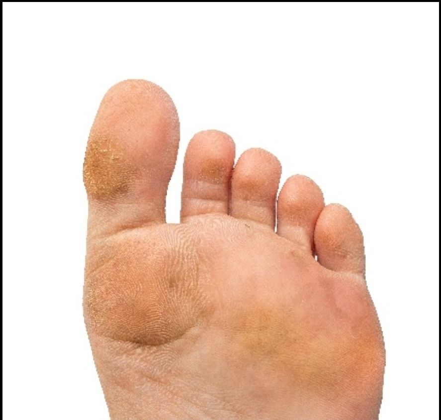 Ilustrasi cedera kaki karena salah pilih sepatu. (dok. RSPI)