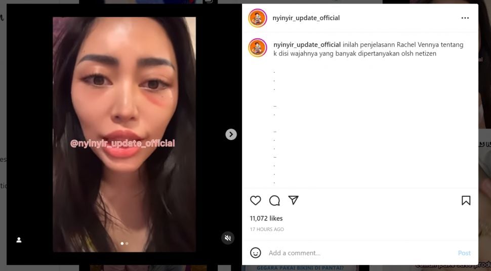 Bagian bawah mata Rachel Vennya bengkak (Instagram nyinyir_update_official)