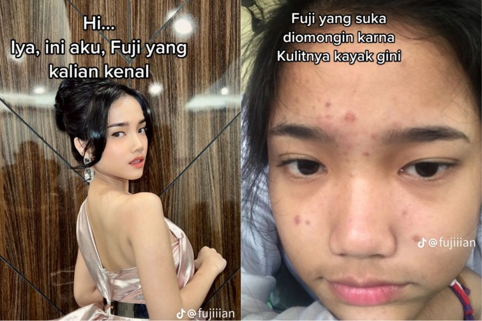 Wajah Berjerawat Fuji di Masa Lalu (TikTok)