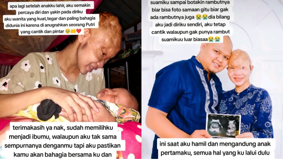 Viral Kisah Wanita yang Tengkorak Kepalanya Rusak karena Kecelakaan Mesin Perahu (TikTok)