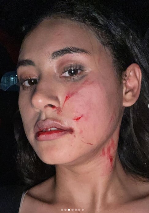 Potret Afifah Riyad setelah diserang mantan pacar suami (Instagram)