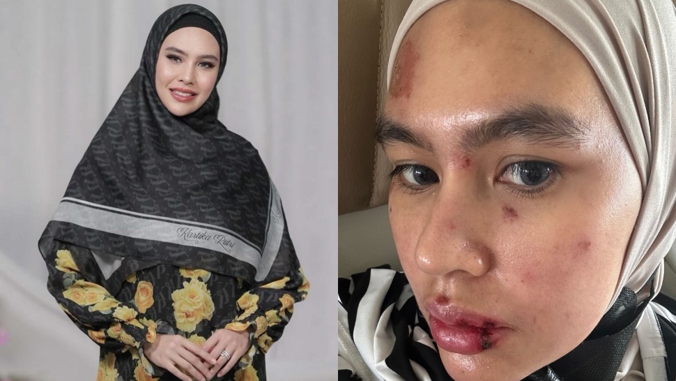 Potret Kartika Putri sebelum dan saat terkena penyakit steven johnson syndrome. (Insagram)