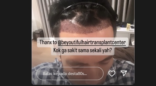 Desta tanam rambut ke Dr. Tompi (Instagram/@desta80s)