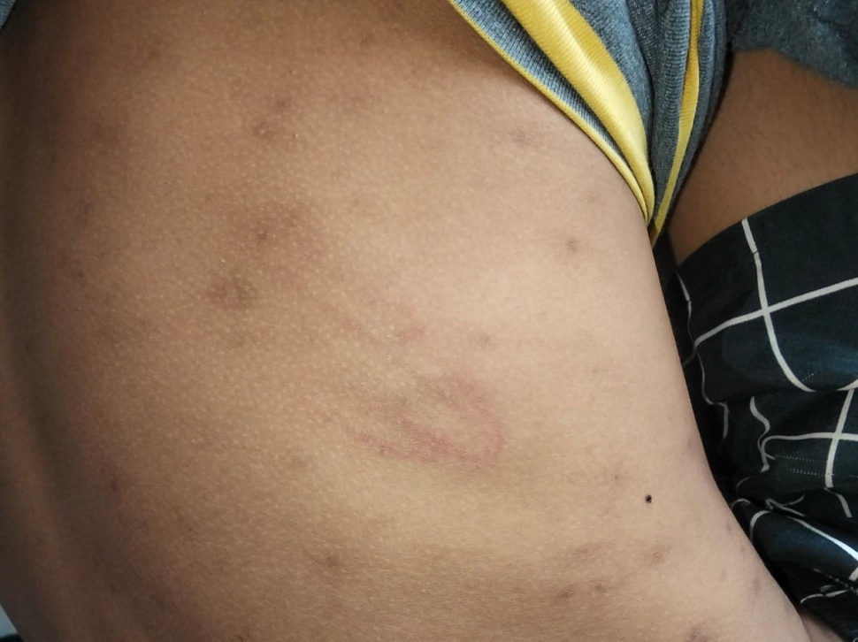 Foto bekas sabetan selang yang mulai memudar di tubuh Dion setelah mendapat penganiayaan di Polres Magelang Kota. [dokumentasi]