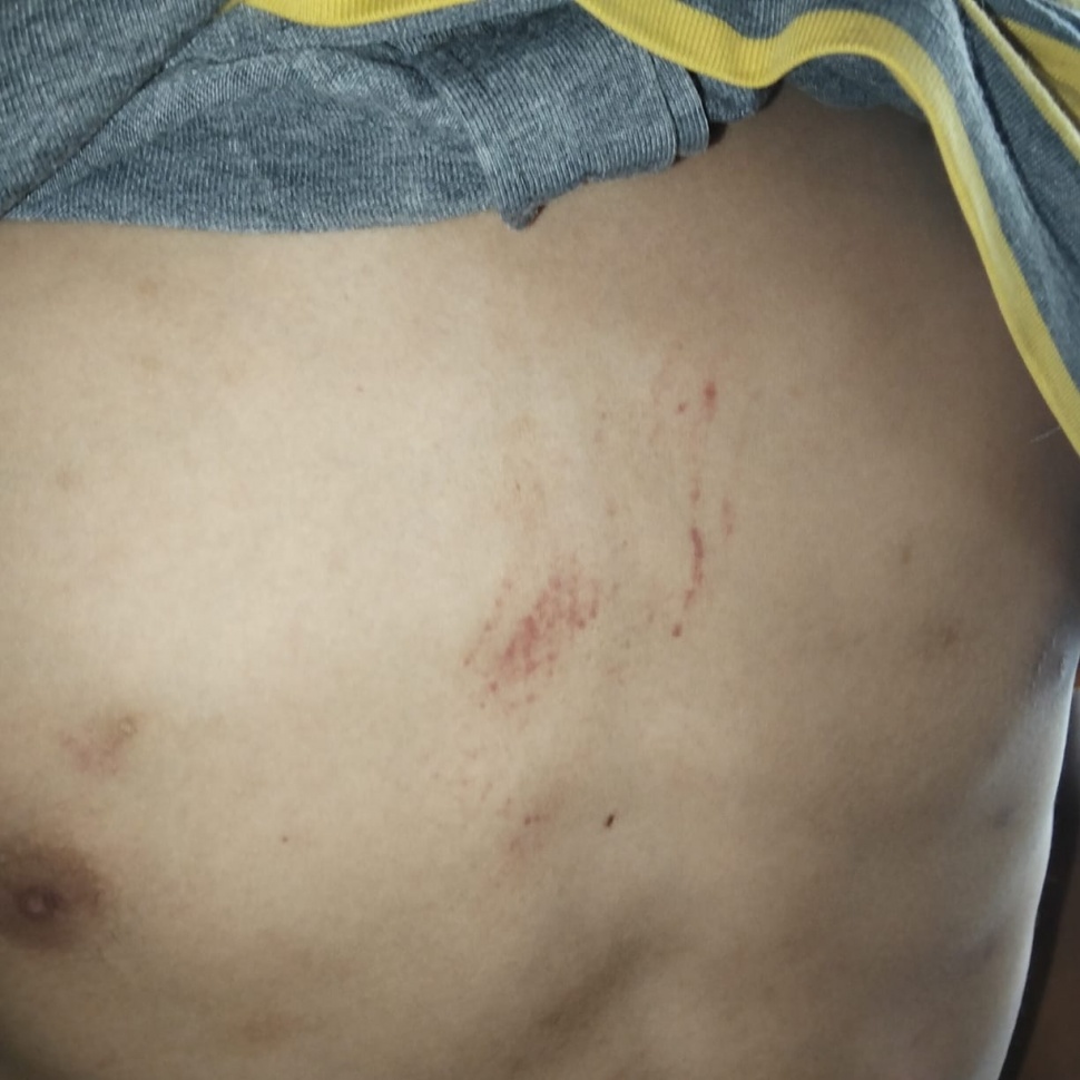 Salah satu bekas luka di dada Dion, yang diduga akibat kekerasan oleh personel Polres Magelang Kota. [Dokumentasi] 