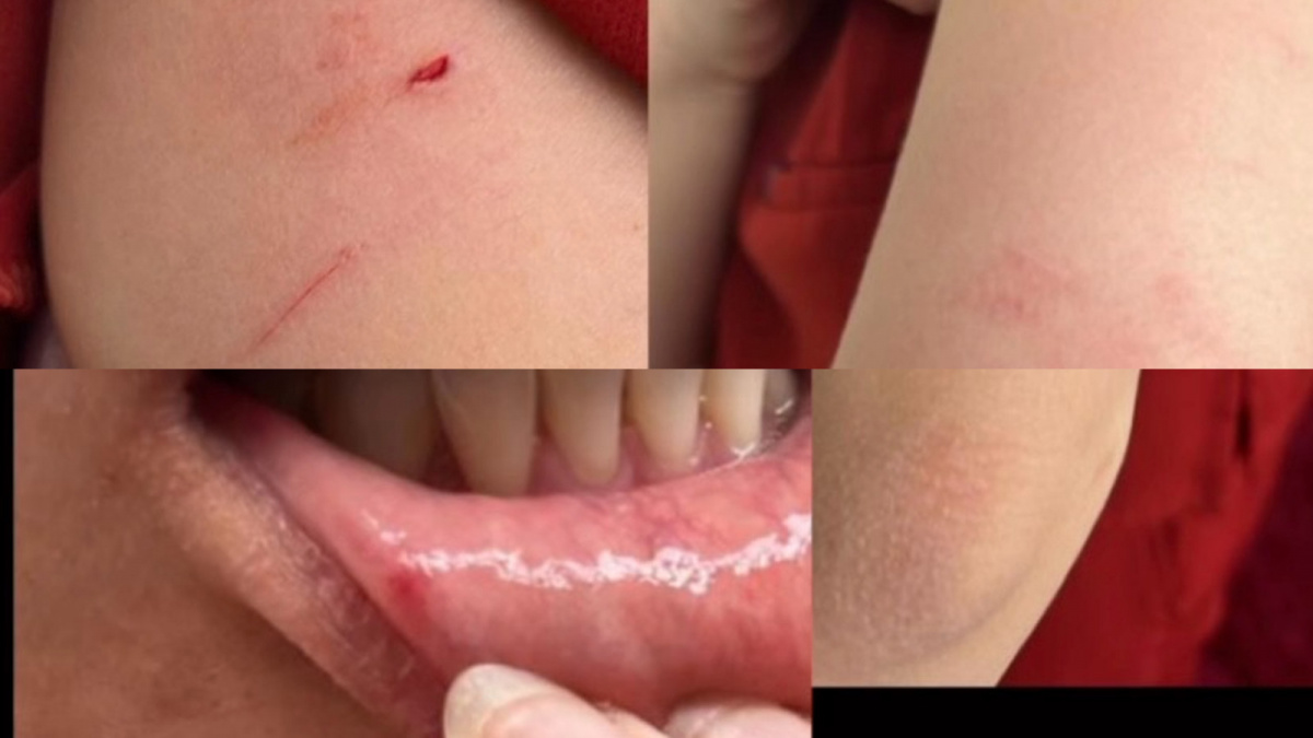 Kondisi Vissiel, korban penganiayaan serta ancaman pembunuhan Samuel Sunarya. (Instagram/vissiel)