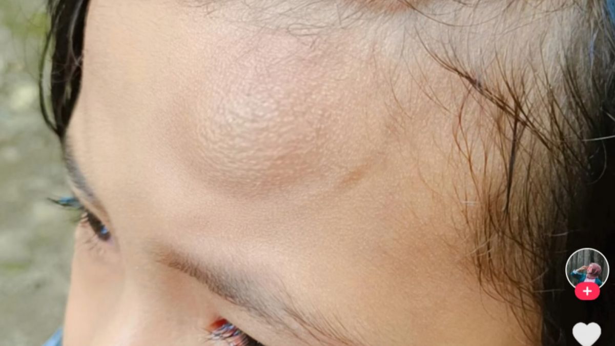 Korban Permainan Lato-lato [[Tiktok/Issey]]