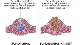 Tips Kesehatan Mencegah Penyakit Tumor ala Dokter Zaidul Akbar