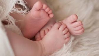 Lahir di Asahan, Bayi Kembar Siam Dirujuk ke RSUP HAM