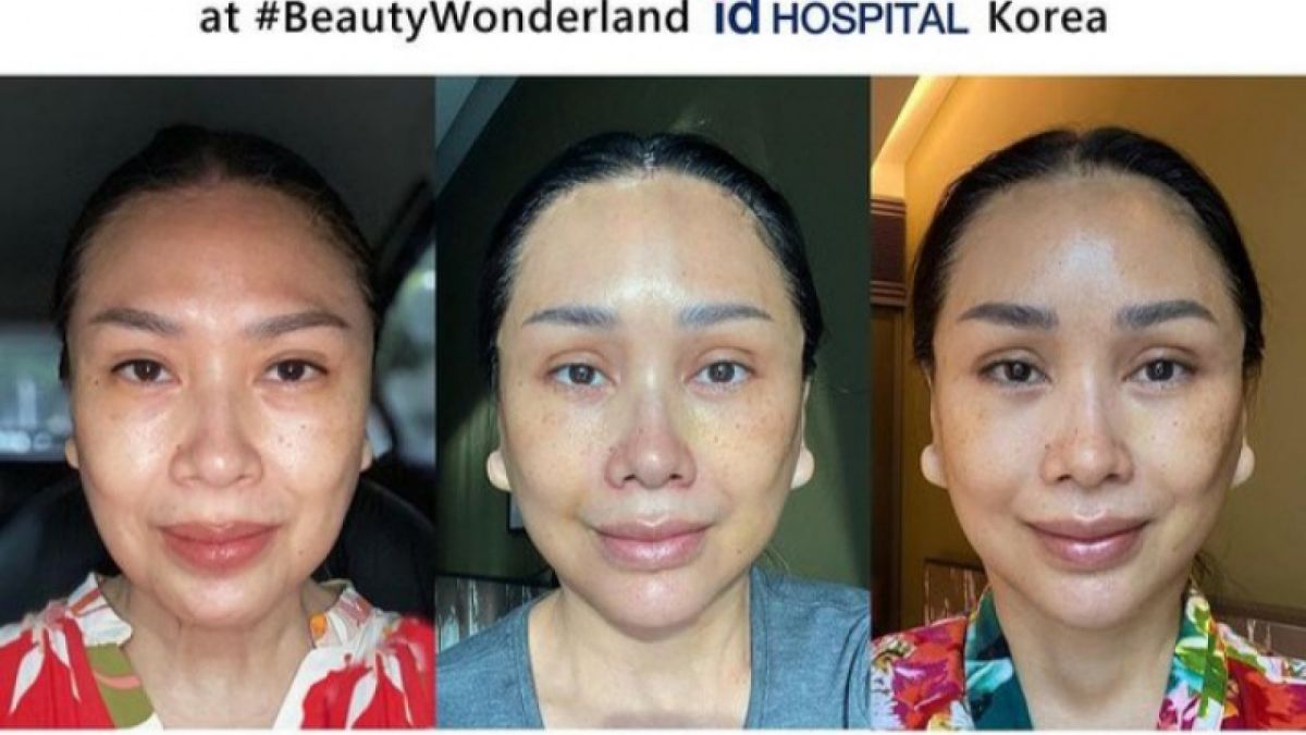 Pamer Wajah Barunya, Ini Rumah Sakit Tempat Titi DJ Oplas Demi Hilangkan Kerutan di Wajah