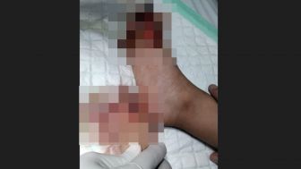 Bocah 3 Tahun Tertimpa Kaca di Hotel Hilton Bali Resort, Jempol Kaki Patah, Pihak Hotel Tak Bertanggung Jawab