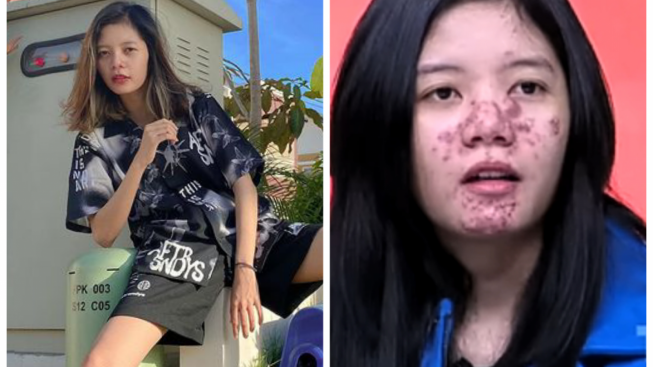 Waduh! Berniat Naikan Berat Badan, Youtuber Ismi Hidayah Mendadak Wajah Dipenuhi Jerawat, Diguna-guna?