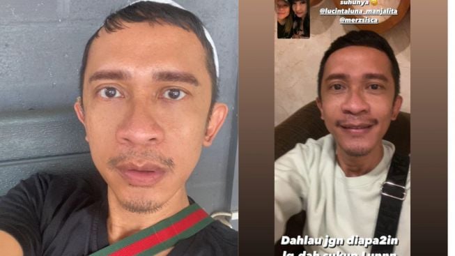 Usai 'Hijrah', Aming Ikut Komentari Hidung Baru Lucinta Luna, Hidung Sendiri Bingung Mau Diapakan