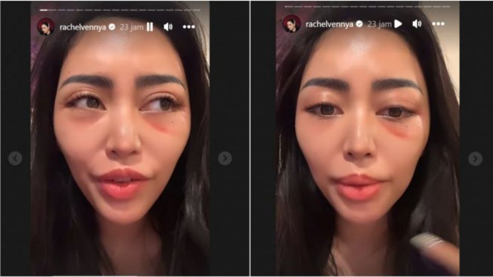 pipi-tirus-rachel-venya-dikomentari-netizen-apa-itu-prosedur-buccal-fat