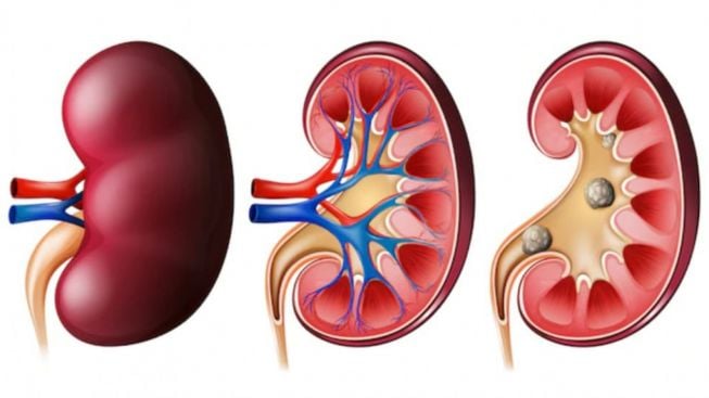 Apakah Gagal Ginjal Akut ada Kaitannya dengan Covid-19? Ini Jawaban Kemenkes RI