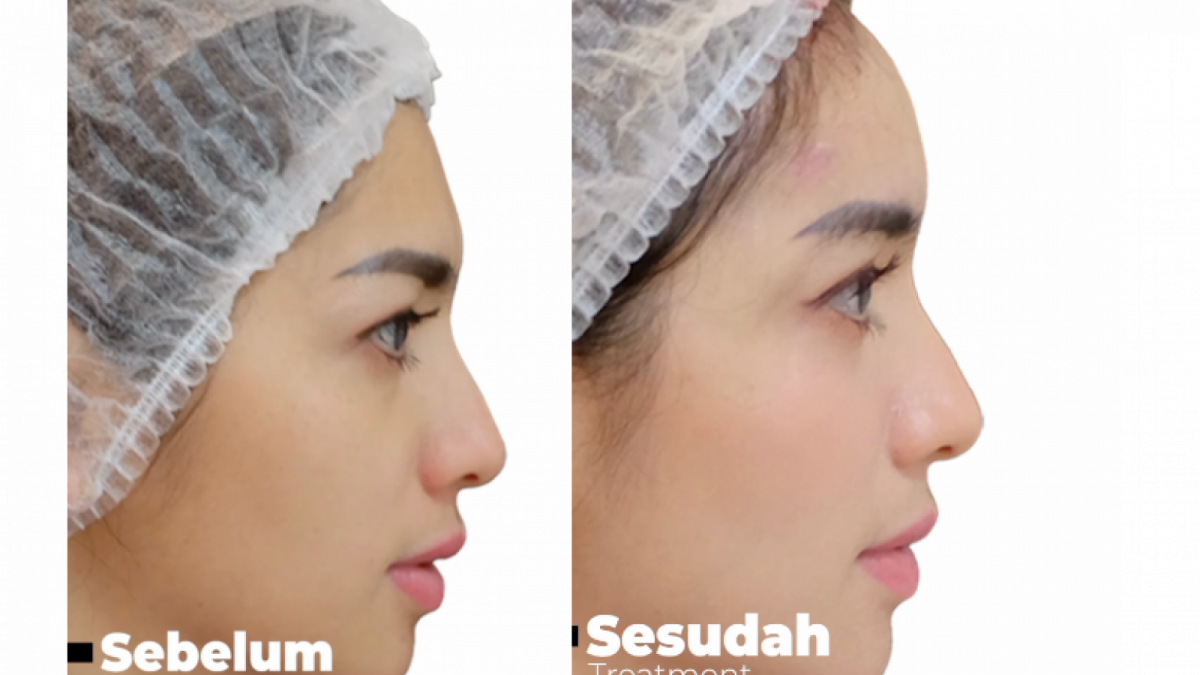 Penampilan Angel Karamoy yang berbeda setelah treatment