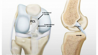 Cegah Osteoporosis Sejak Dini, Coba Ikuti 10 Tips Kesehatan Ini