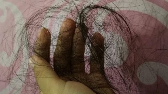 Tidak Ingin Rambut Rontok Hingga Botak, Hindari 7 Makanan dan Minuman ini Kata dr Richad Lee