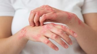 Mengenal Penyakit Scabies, Penyebab, Gejala, dan Cara Perawatannya