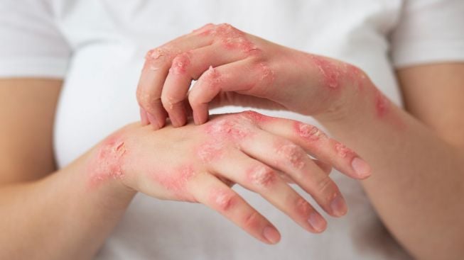 Kenali Scabies Tanda Dan Gejalanya Uptd Puskesmas Lirik Uptd