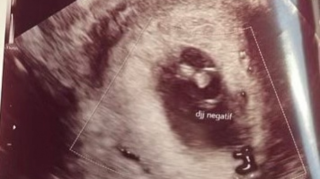 Isyana Sarasvati Keguguran, Apa Penyebab Kondisi Ini dan Bagaimana Pencegahannya