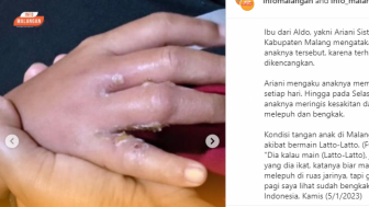 Jemari Bocah di Malang Melepuh dan Bengkak Gegara Terlalu Sering Main Lato-lato