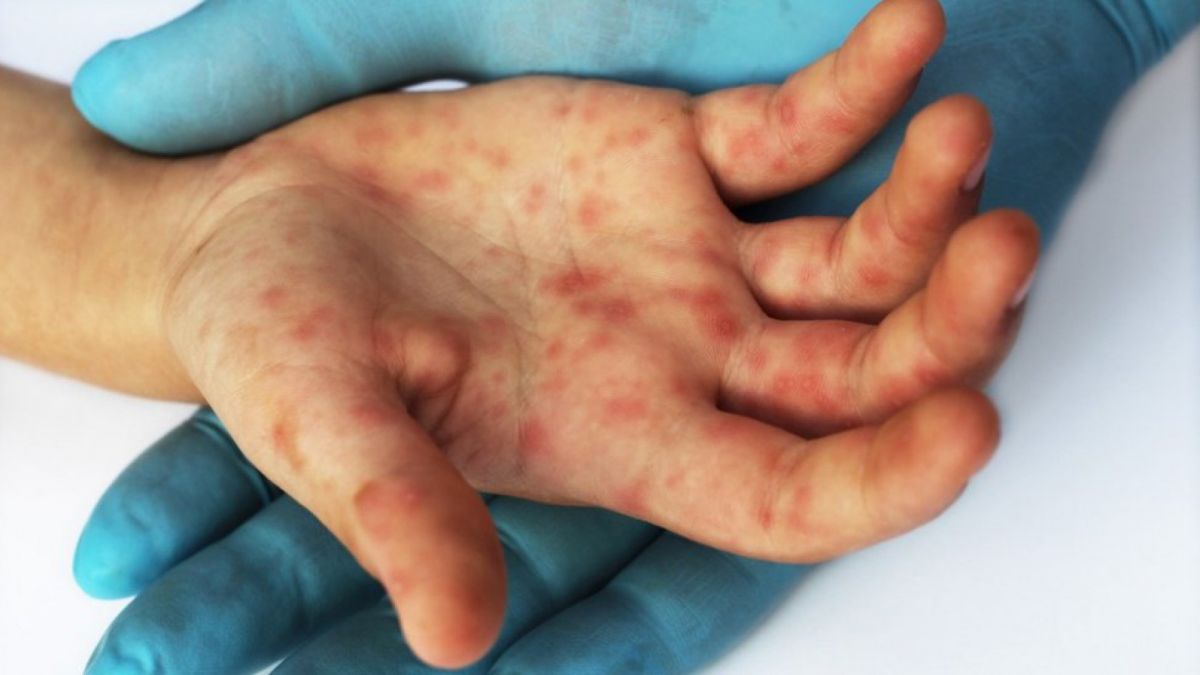 Ilustrasi gejala campak atau cacar. [Suara.com/Shutterstock]