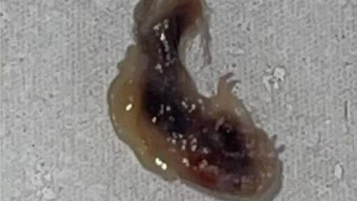 Penampakan parasit yang sempat masuk ke mata Louise Edwards. [Akun FB Louise Edwards/captured]