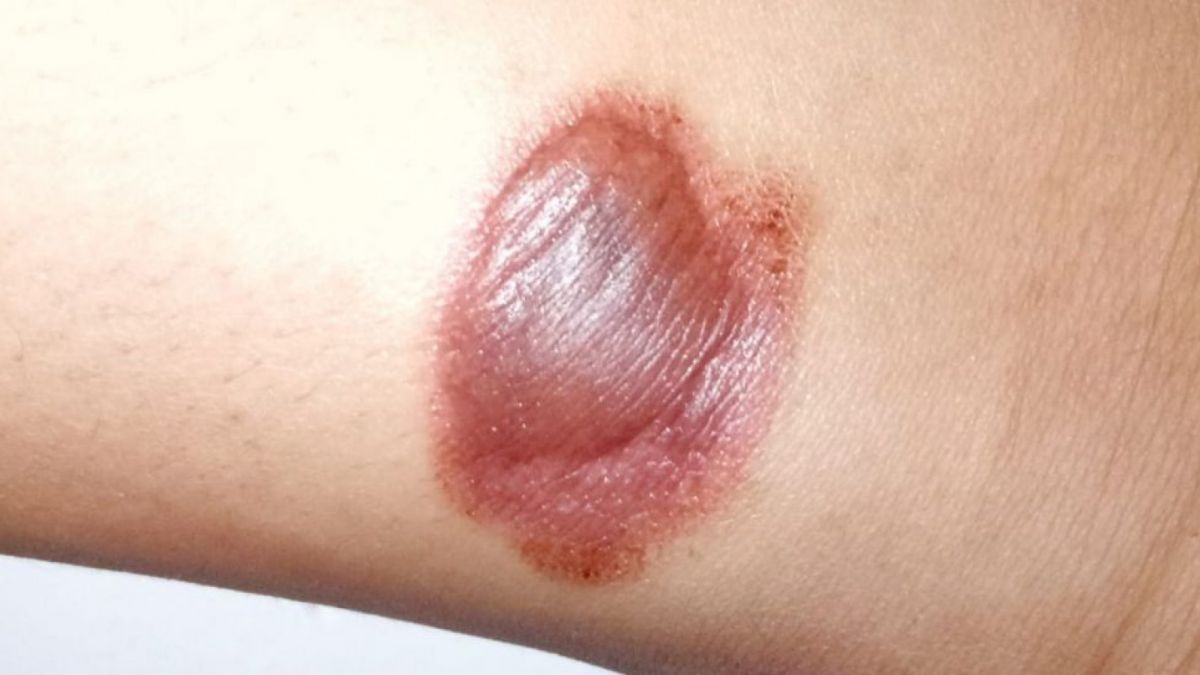 Kulit Mengalami Luka Bakar [suara.com]