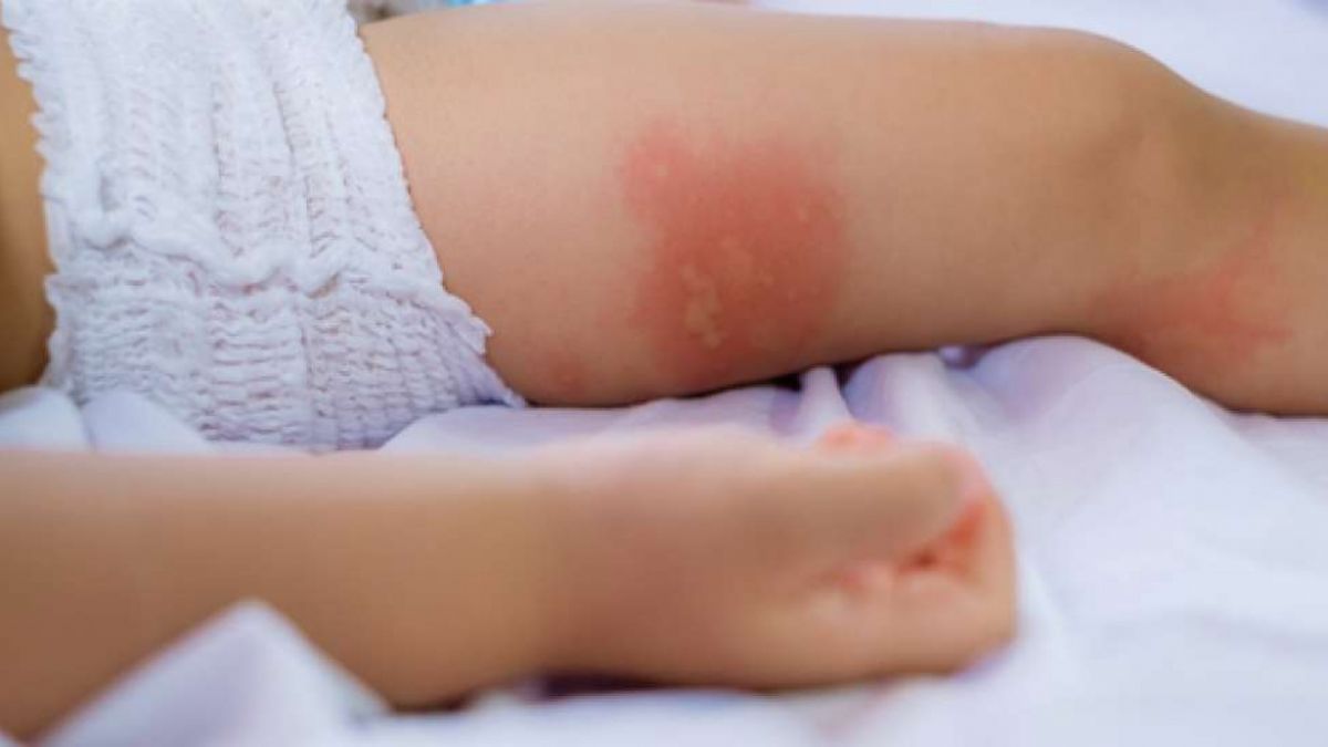 kulit bayi [Shutterstock]