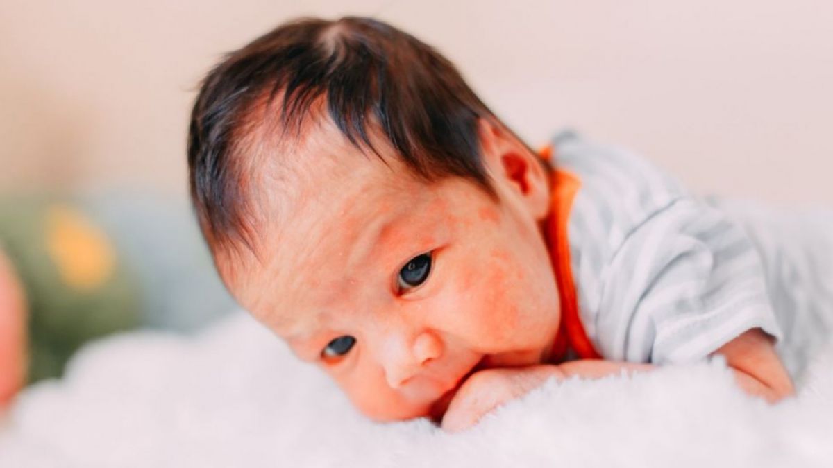 Ilustrasi ruam, eksim, dermatitis atopik [(Elements Envato)]