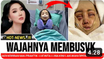 CEK FAKTA: Lucinta Luna Menjadi Korban Malpraktik Hingga Wajahnya Membusuk, Benarkah?