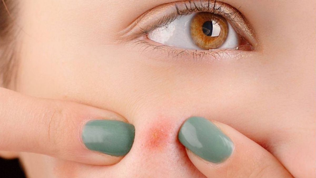 Ilustrasi Jerawat (Pexels.com/Anna Nekrashevich) [suara.com]