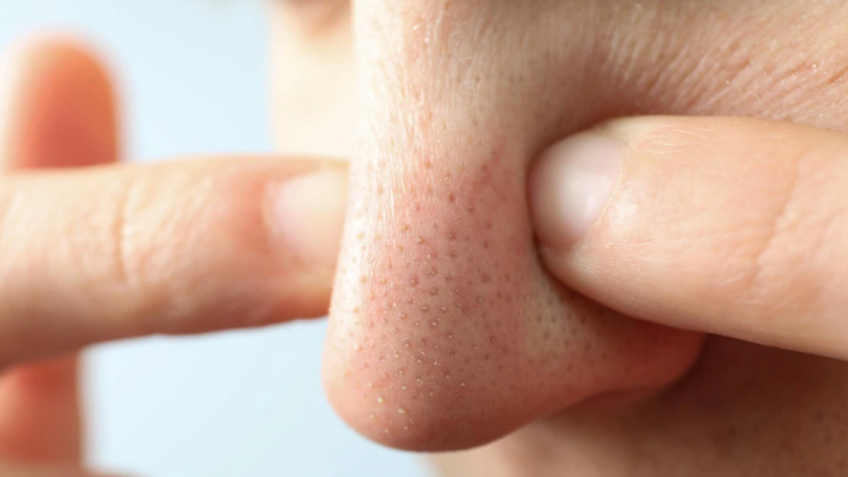 Ilustrasi pori-pori tersumbat [freepik.com]