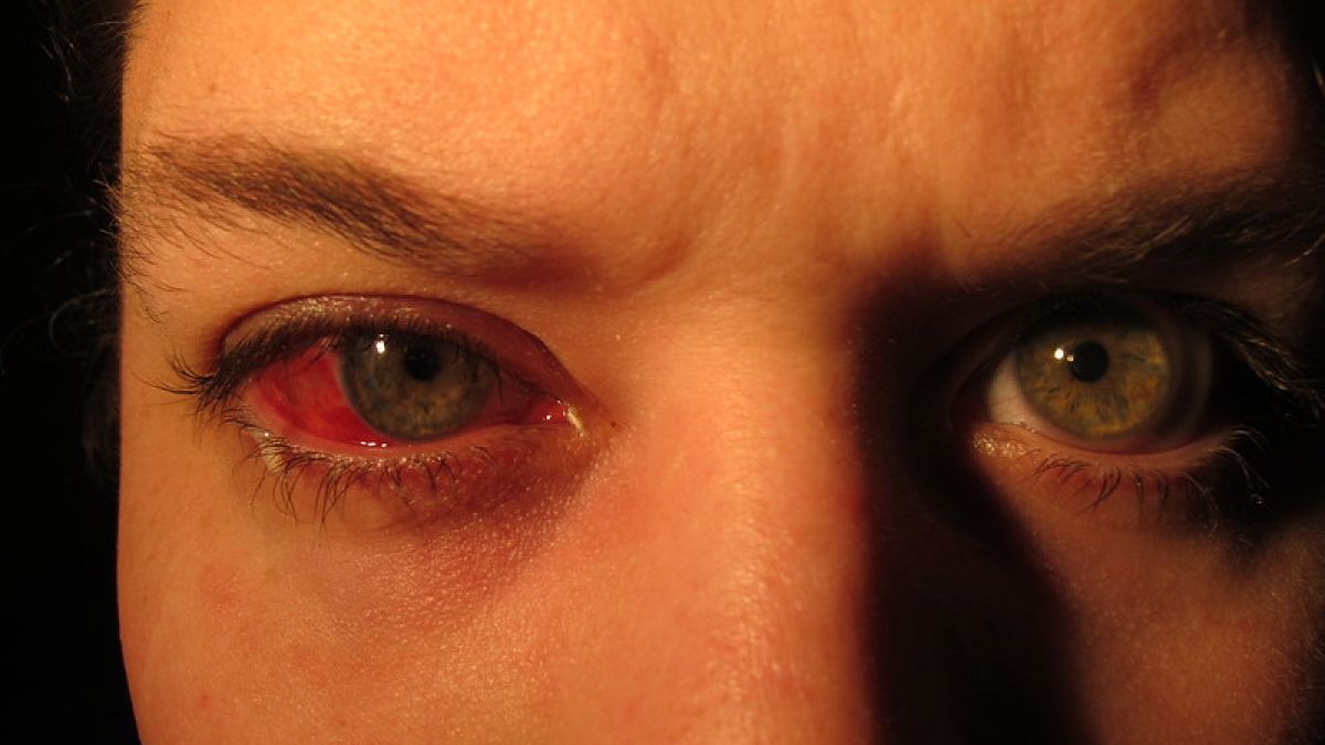 Ilustrasi sakit mata. [Johan/Flickr]