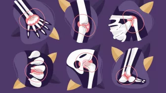 Jangan Anggap Remeh ! Generasi Muda Juga Dapat Alami Osteoarthritis